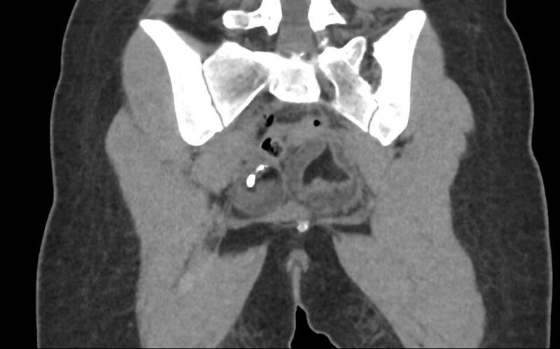 File:Bilateral mature cystic ovarian teratoma (Radiopaedia 88821-105592 Coronal non-contrast 31).jpg
