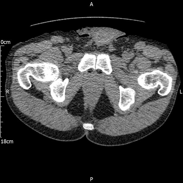 File:Bilateral medullary nephrocalcinosis with ureteric calculi (Radiopaedia 71269-81569 Axial non-contrast 135).jpg