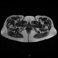 Bilateral ovarian fibroma (Radiopaedia 44568-48293 Axial T2 31).jpg