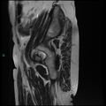 Bilateral ovarian fibroma (Radiopaedia 44568-48293 Sagittal T2 32).jpg