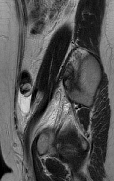 File:Bilateral ovarian fibrothecomas - adolescent (Radiopaedia 86604-102707 Sagittal T2 27).jpg