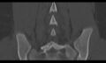 Bilateral pars defect (Radiopaedia 26691-26846 Coronal bone window 36).jpg