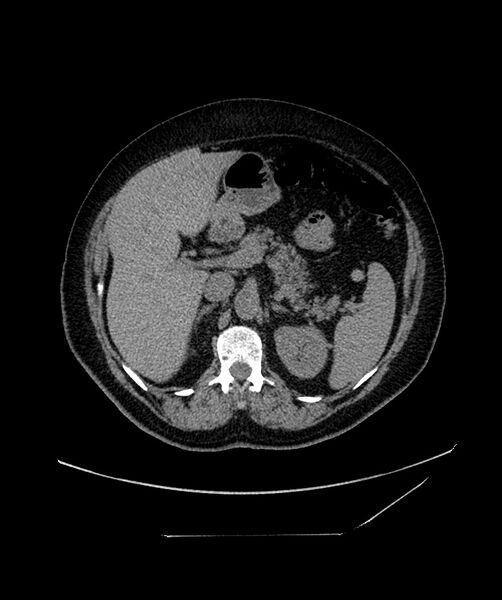 File:Bilateral sporadic synchronous clear cell renal cell carcinoma (Radiopaedia 85035-100573 Axial non-contrast 42).jpg