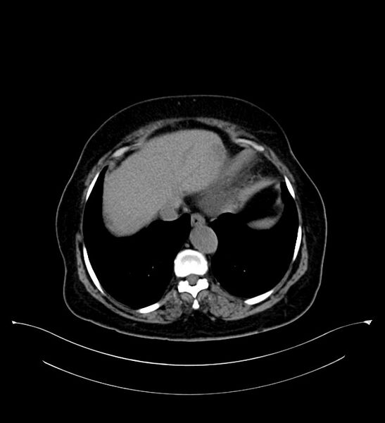 File:Bilateral sporadic synchronous clear cell renal cell carcinoma (Radiopaedia 85035-100575 Axial non-contrast 8).jpg