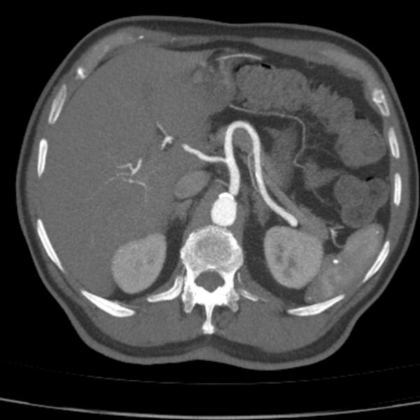 File:Bilateral superficial femoral arterial occlusion (Radiopaedia 25682-25857 A 5).jpg