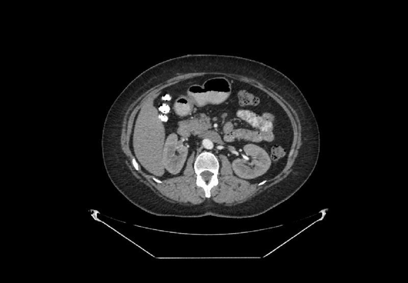 File:Bilateral urolithiasis with incidentally detected splenic artery aneurysm and left inferior vena cava (Radiopaedia 44467-48127 A 38).jpg