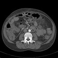 Biliary necrosis - liver transplant (Radiopaedia 21876-21846 A 39).jpg