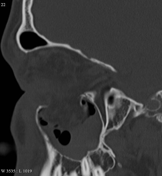 File:Blowout orbital fracture (Radiopaedia 4880-6817 Sagittal bone window 1).jpg