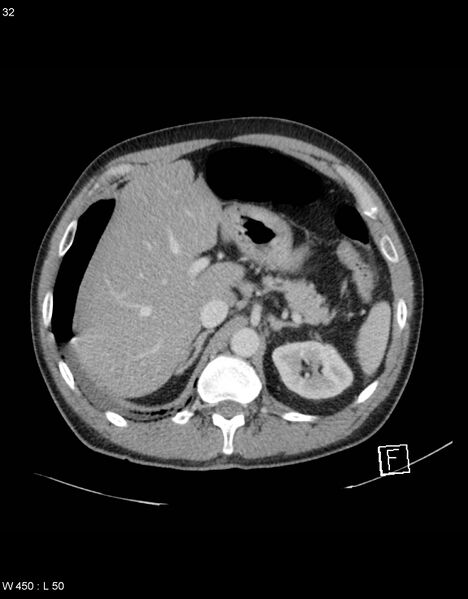 File:Boerhaave syndrome with tension pneumothorax (Radiopaedia 56794-63603 A 16).jpg
