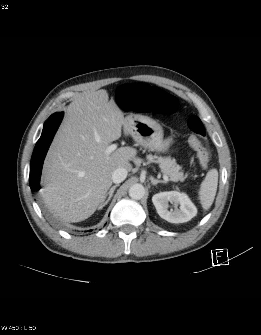 Boerhaave syndrome with tension pneumothorax (Radiopaedia 56794-63603 A 16).jpg