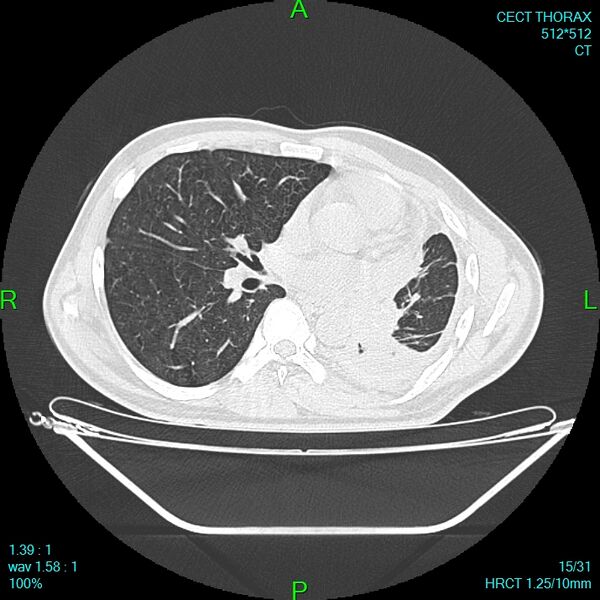 File:Bone metastases from lung carcinoma (Radiopaedia 54703-60937 Axial lung window 15).jpg