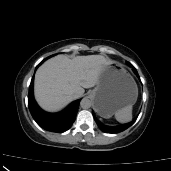 File:Bosniak renal cyst - type I (Radiopaedia 27479-27675 Axial non-contrast 13).jpg