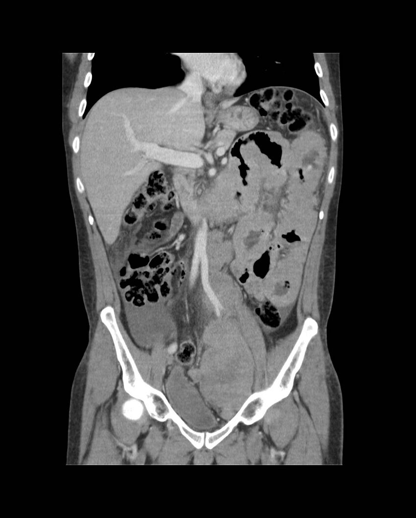 Bowel lymphoma complicated by bleeding after therapy (Radiopaedia 55601-62107 B 33).jpg