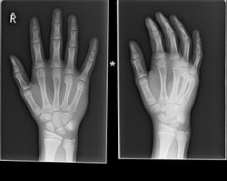 Boxer fracture of the 4th and 5th knuckles