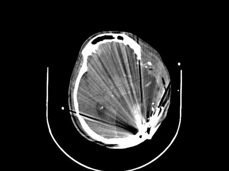 File:Brain injury by firearm projectile (Radiopaedia 82068-96087 B 104).jpg