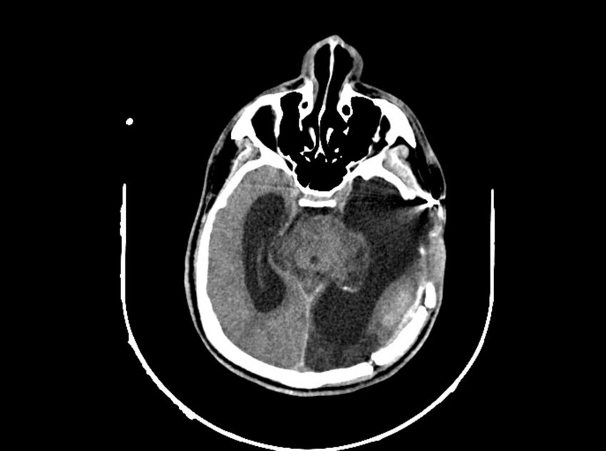 Brain injury by firearm projectile (Radiopaedia 82068-96088 A 112).jpg
