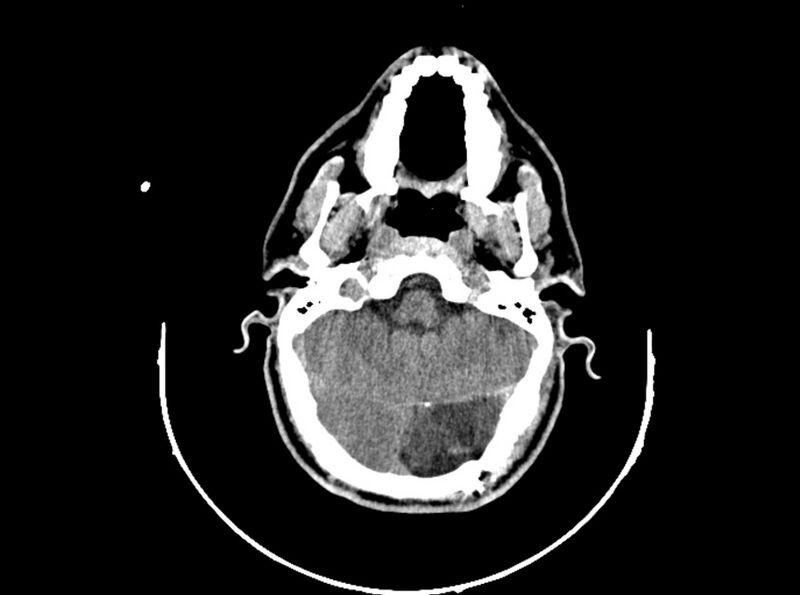 File:Brain injury by firearm projectile (Radiopaedia 82068-96088 A 79).jpg