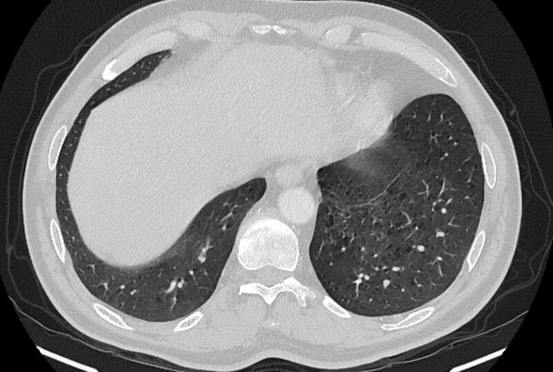 File:Brain metastases - lung cancer primary (Radiopaedia 75060-86116 Axial lung window 50).jpg