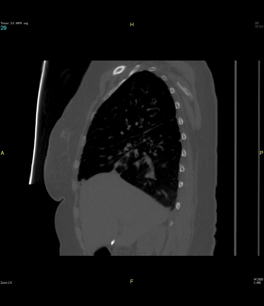 Breast primary with lung and bone metastases (Radiopaedia 40620-43228 Sagittal bone window 29).jpg