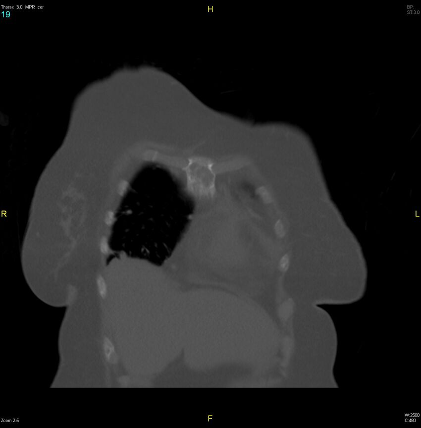 Breast primary with lung and bone metastases (Radiopaedia 40620-43228 bone window 19).jpg