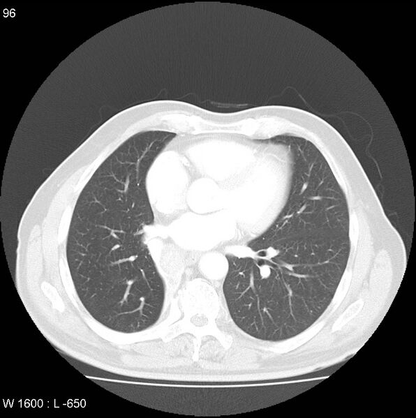 File:Bronchial carcinoid tumor with right lower lobe collapse (Radiopaedia 29060-29422 B 34).jpg