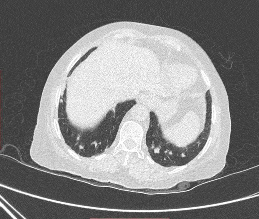 Bronchiectasis (Radiopaedia 72693-83293 Axial lung window 117).jpg