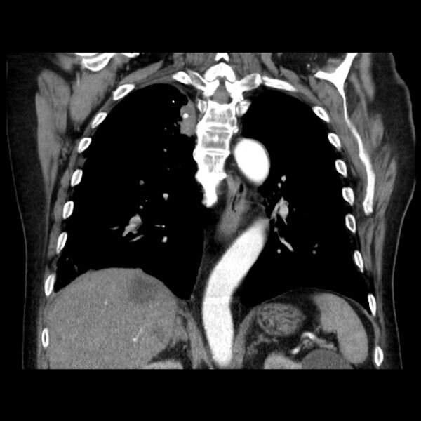 File:Bronchogenic adenocarcinoma and pulmonary embolism (Radiopaedia 9097-9806 C 33).jpg