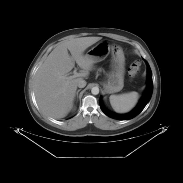 File:Bronchogenic carcinoma with upper lobe collapse (Radiopaedia 29297-29726 C 31).jpg