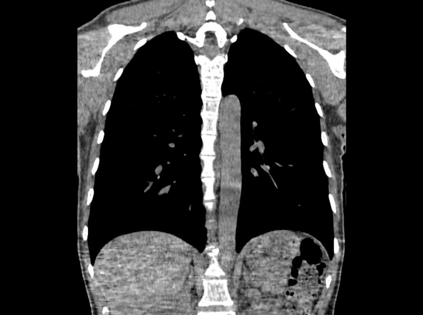 Bronchogenic cyst (Radiopaedia 80273-93615 D 57).jpg
