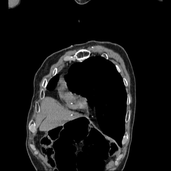 File:Bronchopleural fistula - postoperative complication (Radiopaedia 21020-20947 Coronal non-contrast 5).jpg