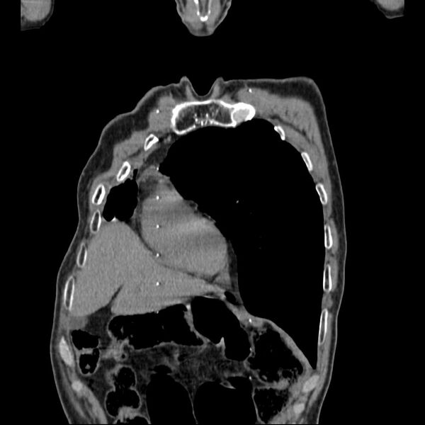 File:Bronchopleural fistula - postoperative complication (Radiopaedia 21020-20947 Coronal non-contrast 7).jpg