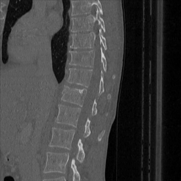 File:Bulging of paraspinal line in traumatic thoracal spinal compression fracture (Radiopaedia 29221-35872 Sagittal bone window 19).jpg