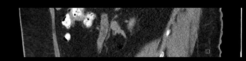 Buried bumper syndrome - gastrostomy tube (Radiopaedia 63843-72575 Sagittal Inject 79).jpg