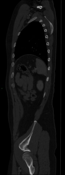 File:Burst fracture (Radiopaedia 83168-97542 Sagittal bone window 99).jpg