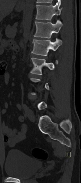 File:Calcaneal fractures with associated L2 burst fracture (Radiopaedia 71671-82493 Sagittal bone window 21).jpg