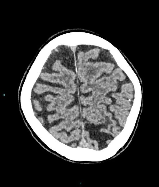 File:Calcified cerebral emboli from left ventricular thrombus (Radiopaedia 84420-99758 Axial non-contrast 21).jpg