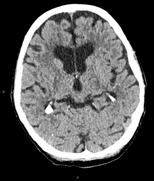 File:Calcified cerebral emboli from left ventricular thrombus (Radiopaedia 84420-99758 Axial non-contrast 53).jpg