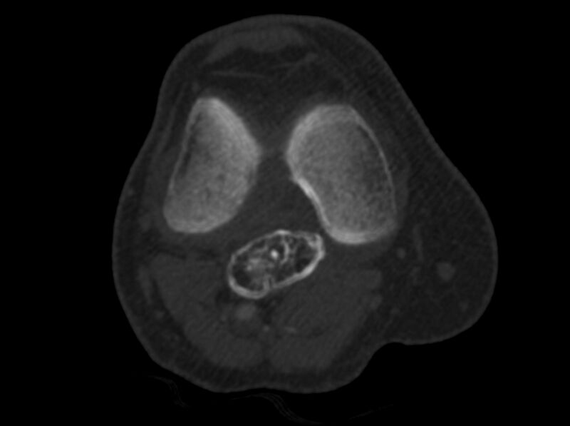 File:Calcified hematoma - popliteal fossa (Radiopaedia 63938-72763 C 15).jpg