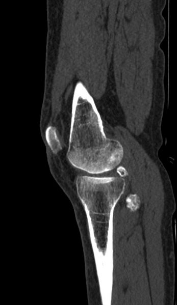 File:Calcified hematoma - popliteal fossa (Radiopaedia 63938-72763 Sagittal bone window 4).jpg