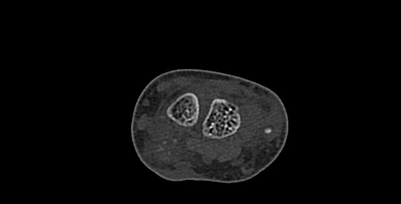 File:Calcifying aponeurotic fibroma (Radiopaedia 88423-105064 Axial bone window 51).jpg