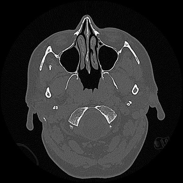 File:Canal up mastoidectomy (Radiopaedia 78108-90638 Axial bone window 3).jpg