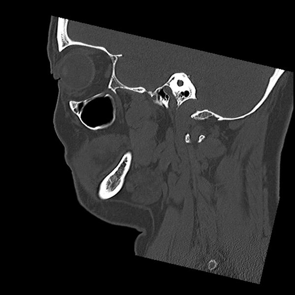 File:Canal up mastoidectomy (Radiopaedia 78108-90638 Sagittal bone window 20).jpg