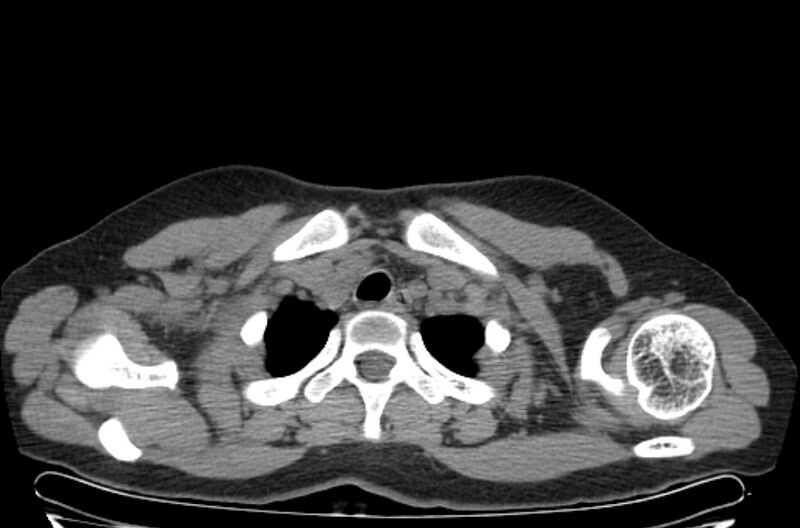 File:Cannonball metastases - uterine choriocarcinoma (Radiopaedia 70137-80173 Axial non-contrast 1).jpg
