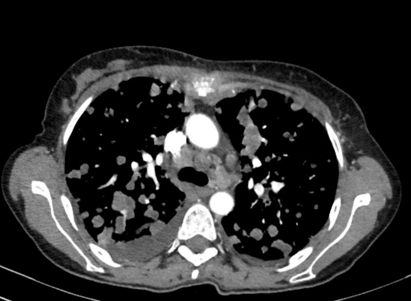 File:Cannonball metastases from breast cancer (Radiopaedia 91024-108569 A 45).jpg