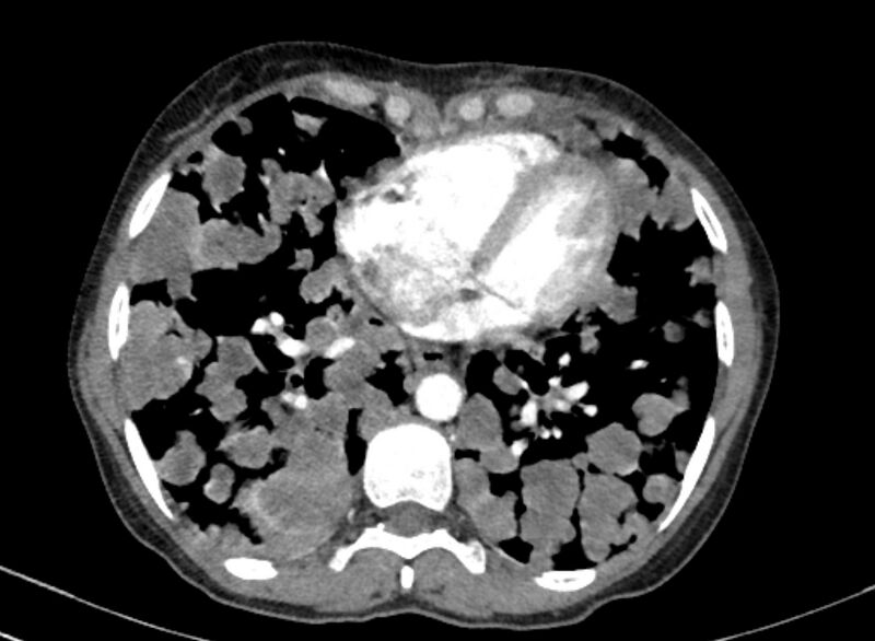 File:Cannonball metastases from breast cancer (Radiopaedia 91024-108569 A 82).jpg