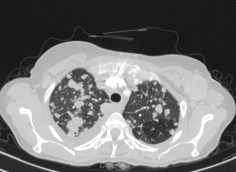 File:Cannonball metastases from breast cancer (Radiopaedia 91024-108569 Axial lung window 17).jpg