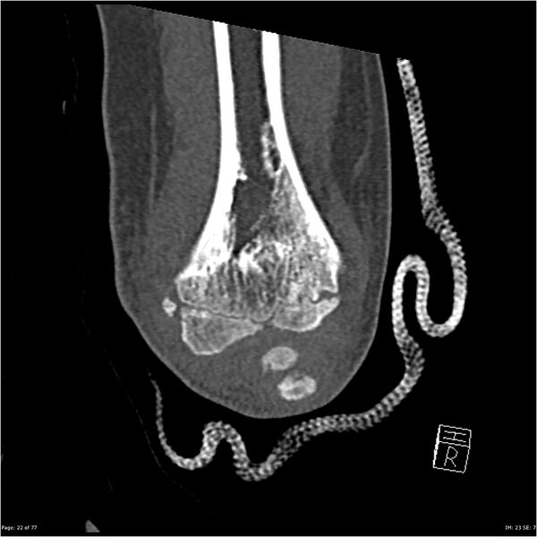 File:Capitellum fracture (Radiopaedia 23352-23426 Coronal bone window 22).jpg