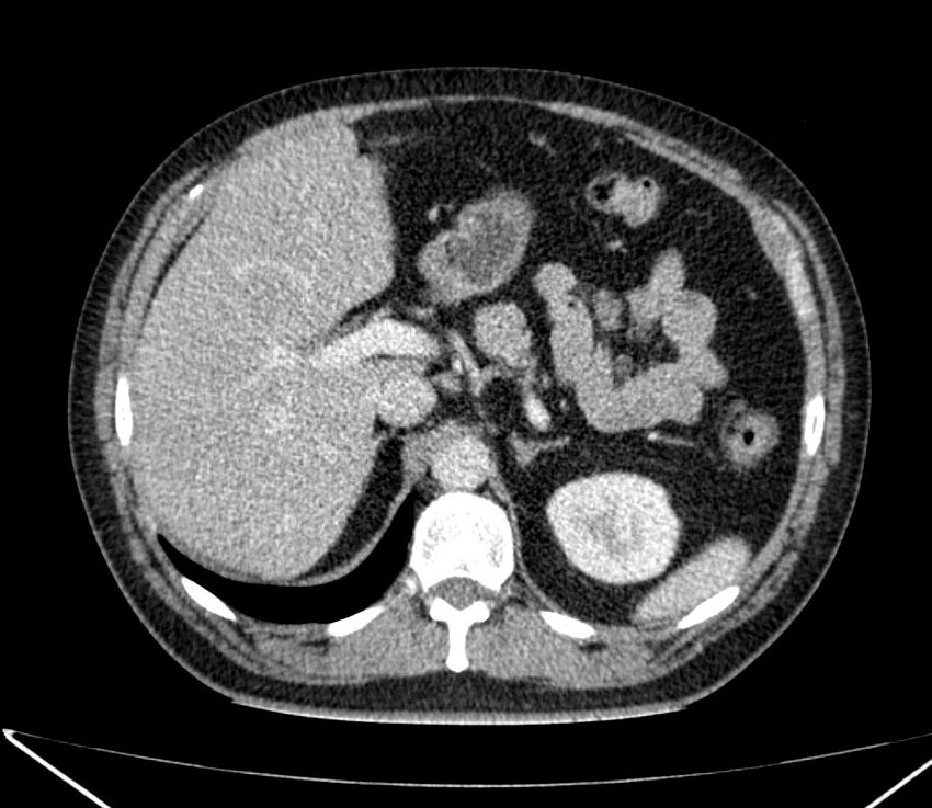 Carcinoid tumor with hepatic metastases (Radiopaedia 22651-22670 C 39).jpg