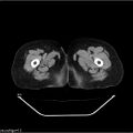 Carcinoma cervix- recurrence (Radiopaedia 34702-36137 B 61).jpg