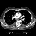 Cardiac tamponade (Radiopaedia 78607-91368 Axial C+ CTPA 36).jpg